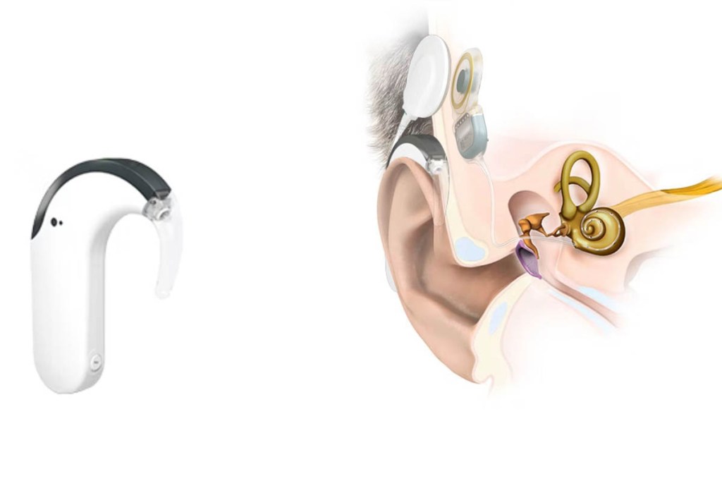 Ein Cochlea-Implantat und eine Zeichnung, die seinen Sitz im Ohr zeigt.